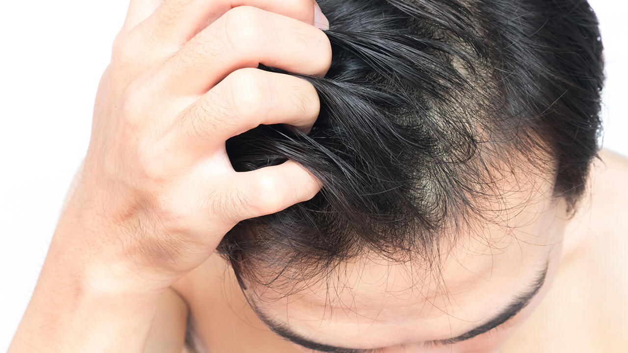 Juckreiz ist ein bekanntes Symptom für schuppige Kopfhaut.